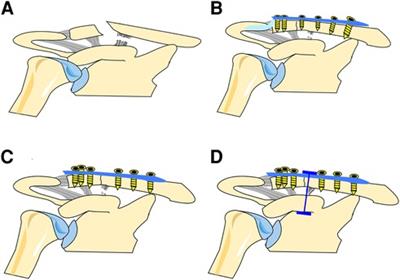 Comparative study of three different fixation techniques for the treatment of Neer type IIb distal clavicle fractures: A retrospective cohort study